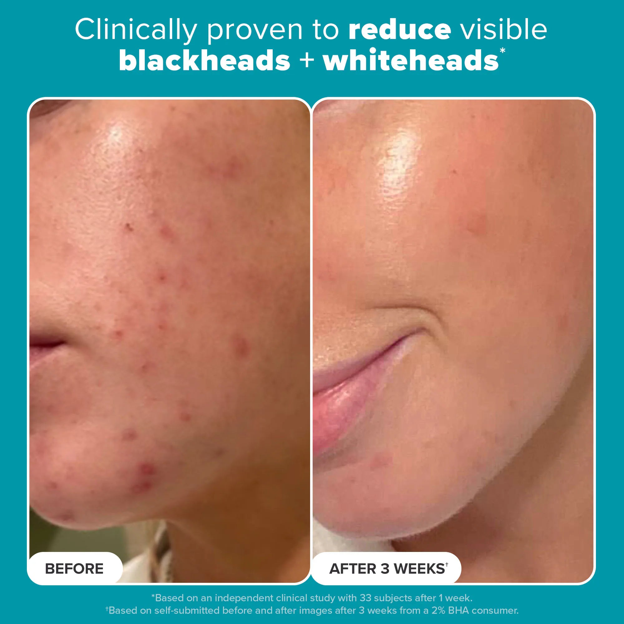 Tónico exfoliante Skin Perfecting 2% BHA – Para una piel más limpia y uniforme